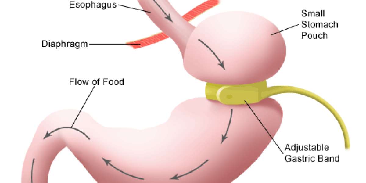 Who Needs LAP-BAND Gastric Surgery? Know About Procedure And Preparation